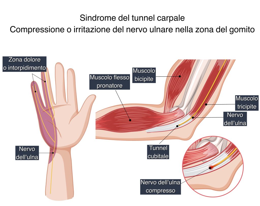 tennis e sindrome del tunnel carpale